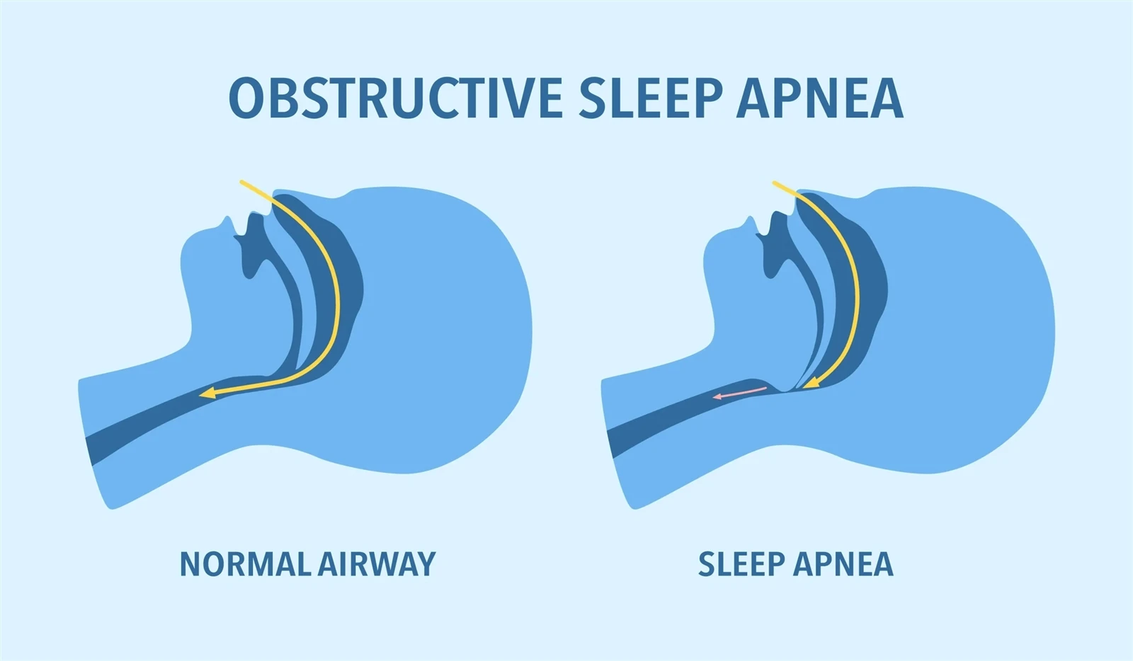Retatrutide Obstructive sleep apnea | Bloomtechz Retatrutide Obstructive sleep apnea | Bloomtechz