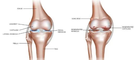 Retatrutide Merging knee osteoarthritisMerging knee osteoarthritis | Bloomtechz Retatrutide Merging knee osteoarthritisMerging knee osteoarthritis | Bloomtechz