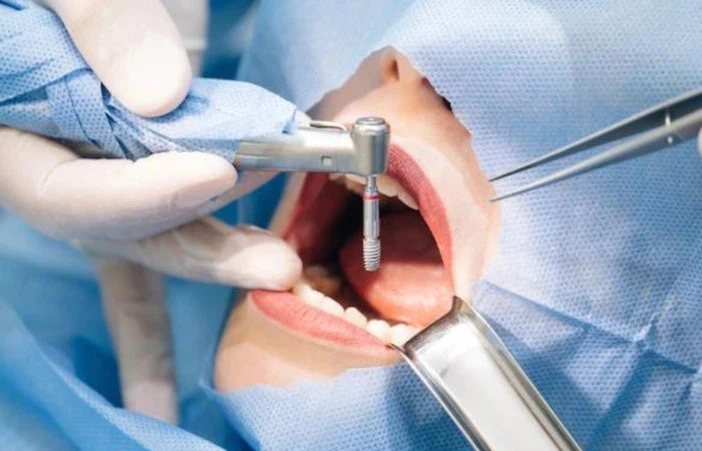 Larocaine dental surgeries | Shaanxi BLOOM Tech Co., Ltd Larocaine dental surgeries | Shaanxi BLOOM Tech Co., Ltd