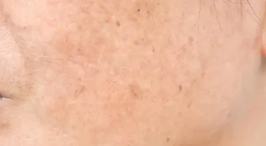 Nonapeptide-1 clinical cutaneous hyperpigmentation | Shaanxi BLOOM Tech Co., Ltd Nonapeptide-1 clinical cutaneous hyperpigmentation | Shaanxi BLOOM Tech Co., Ltd